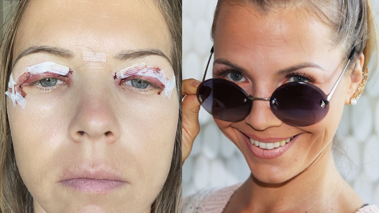 Read more about the article Blefaroplasty – Eyelid Surgery – Personal Experience